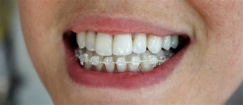 How Does Six Month Smiles Braces Work? All You Need to Know