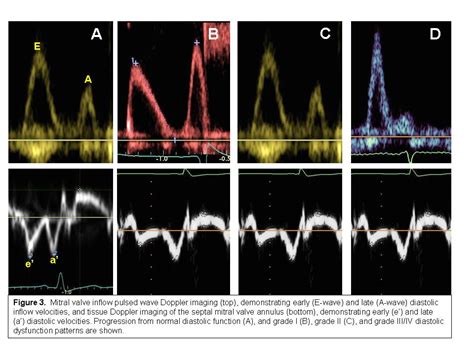 Lv Diastolic Dysfunction Grade 3 | IUCN Water