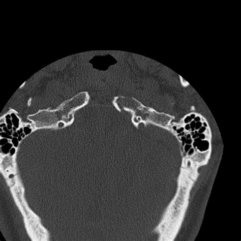 Occipital condyle fracture (Radiopaedia 31755-32691 Axial bone window ...