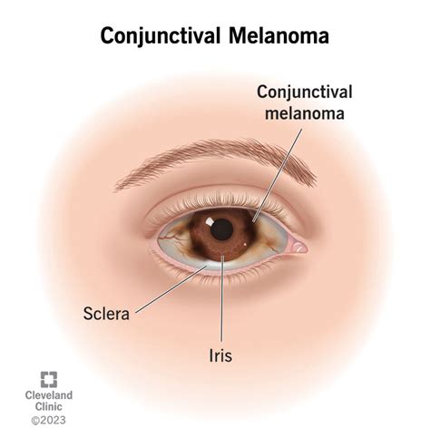 Conjunctival Melanoma: Symptoms & Treatment