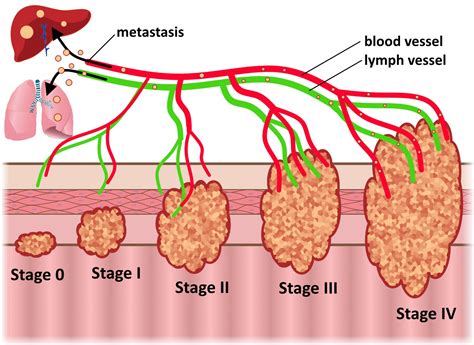 Stages Of Cancer Tumor Size