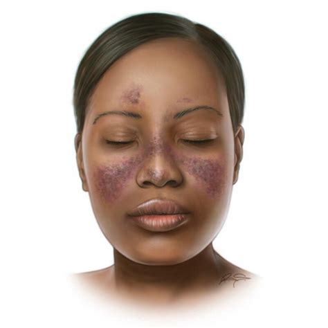 How to navigate the signs of lupus in the Black community