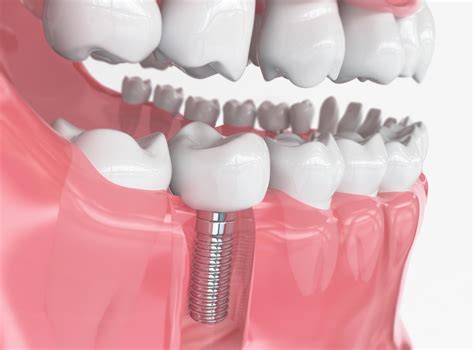 Your Guide to the Different Types of Dental Implants