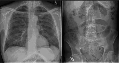 Plain film of the chest and abdomen: the chest X-ray shows features ...