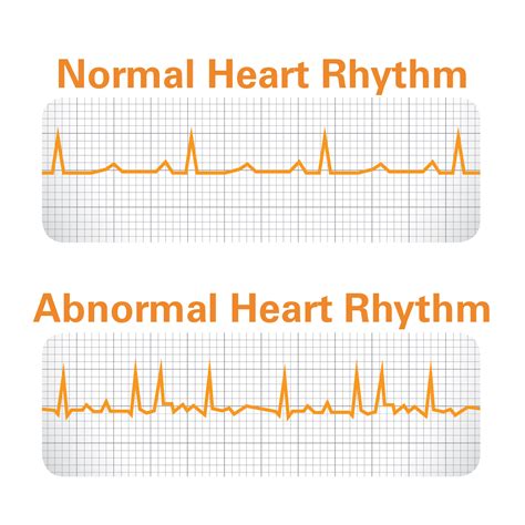 Atrial Fibrillation diagnosis | Get Smart About AFIB