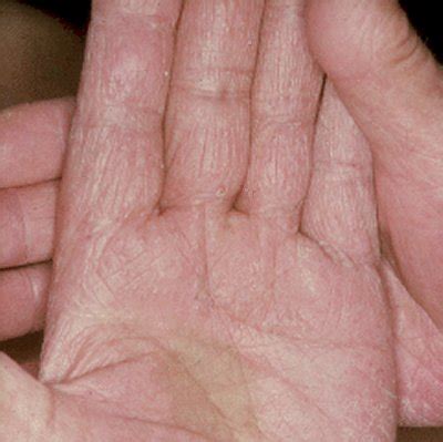 Fungal Infection Images - Tinea Manuum