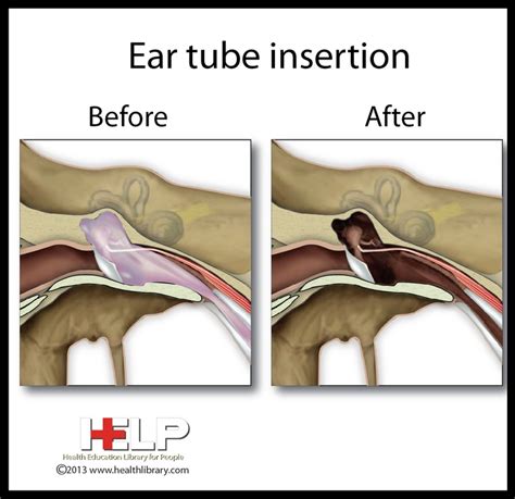 Ear Tube Insertion | Ear | Pinterest | Ear tubes