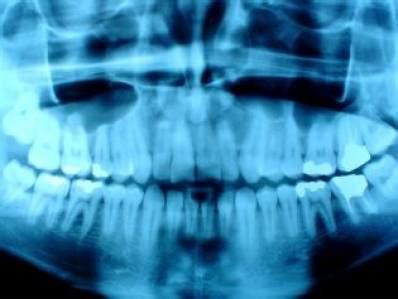 Jaw Bone Cancer: Signs and When Surgery Required | UtoDent.com