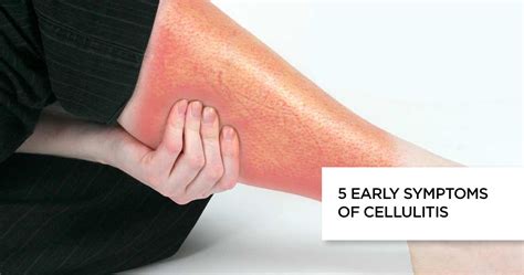 5 Early Symptoms of Cellulitis : Causes, Treatment and Faq's