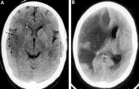 RADIOLOGY OF STROKE | Journal of Neurology, Neurosurgery & Psychiatry