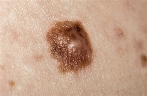 Pictures of cancerous moles: early stage, cancerous moles images ...