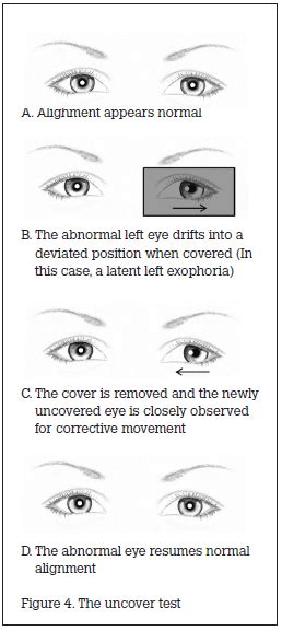 Screening for Strabismus | Squint Examination - Utsav Eye Clinic