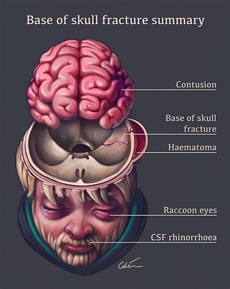 Hinge Fracture Skull