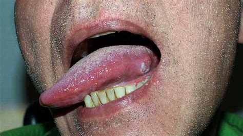 Mouth Cancer Bumps Under Tongue