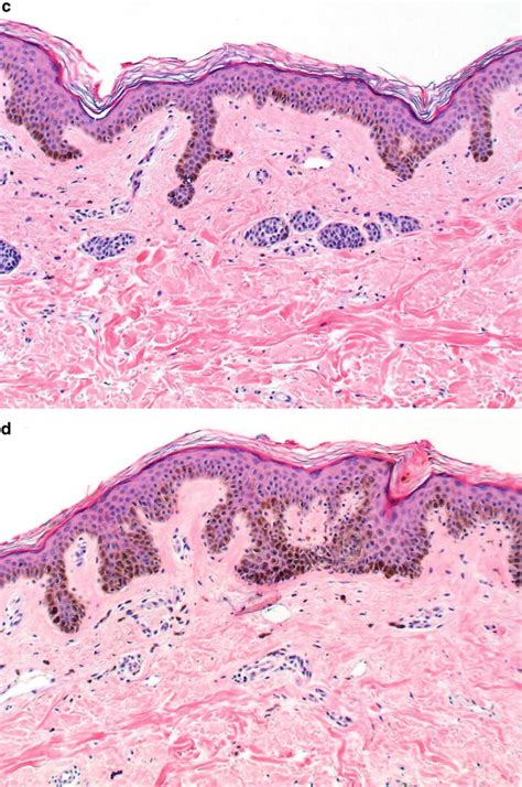 Acquired Melanocytic Nevus | Basicmedical Key