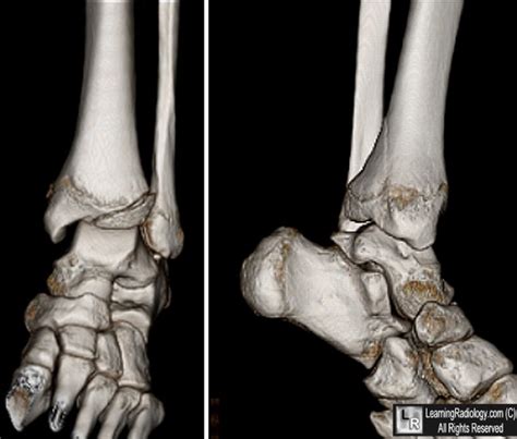 LearningRadiology - Triplane, Fracture, tibia, tillaux, distal, ankle ...