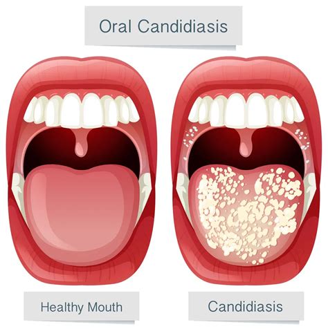 Management Of Oral Thrush