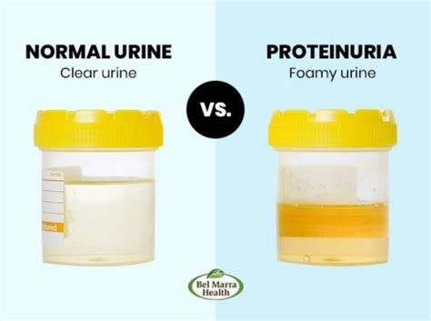 Proteinuria (High Protein in Urine): Causes, Complication and Symptoms