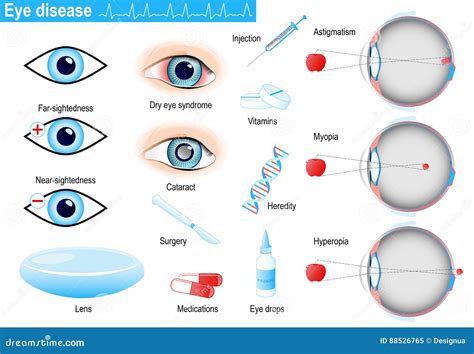 Human Eye Diseases and Disorders. Infographic Stock Vector ...