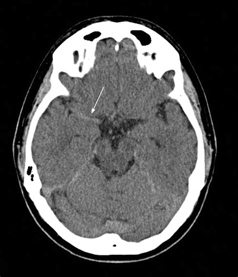 Malignant: Malignant Mca Syndrome