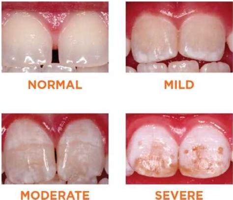 Mild Tooth Decay