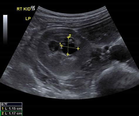 Medullary cystic kidney disease causes, symptoms, diagnosis & treatment