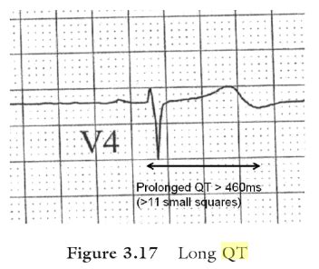 Prolonged QT Interval : Mnemonics | Epomedicine