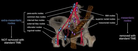 Pelvic nodal staging of rectal cancer. Diagram depicts aspects of ...