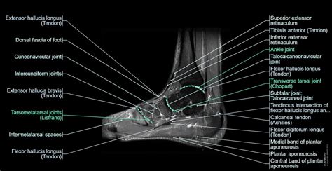 Ankle Tendon Anatomy Mri | Images and Photos finder