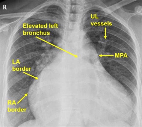 Biatrial enlargement on CXR – All About Cardiovascular System and Disorders