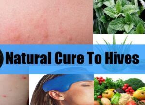 10 Best Hives Home Remedies