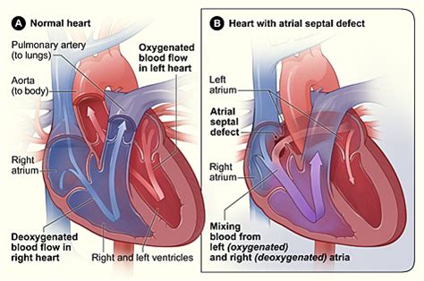 Congenital Heart Defects | NHLBI, NIH