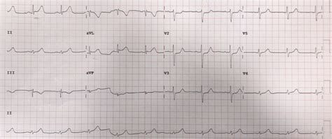 IT'S TIME FOR A QUICK ECG QUIZ! - CARDIAC BOOTCAMP