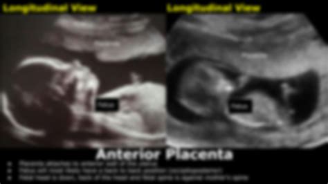 SOLUTION: Placenta positions on ultrasound - Studypool