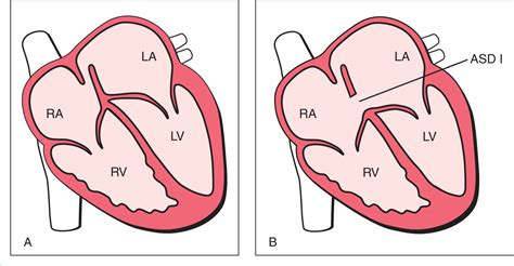 Atrioventricular Septal Defect