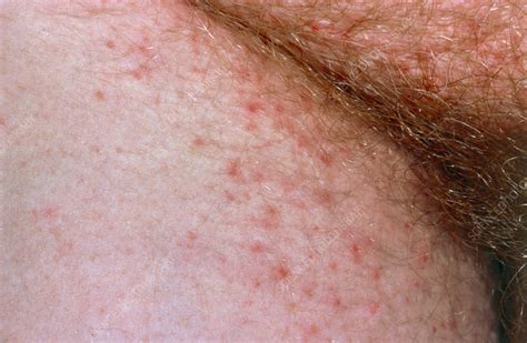 Scabies infection near the groin - Stock Image - M260/0097 - Science ...