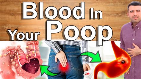 Blood In Your Poop - Bloody Stools - What It Looks Like and What It ...