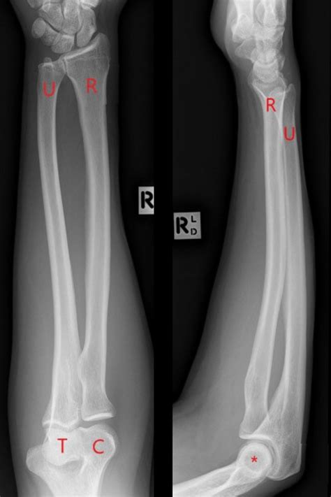 Midshaft radius and ulna fractures - Don't Forget the Bubbles