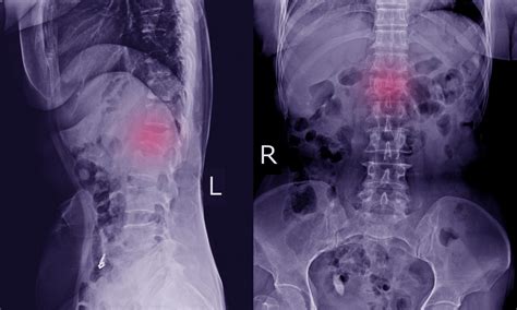 L1 Compression Fracture - Figgymcfatty