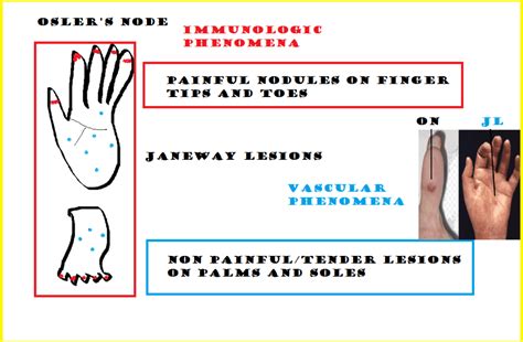 Osler Nodes and Janeway Lesions