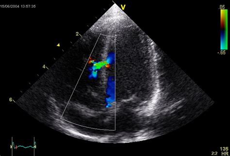 Ventricular septal defect echocardiography - wikidoc