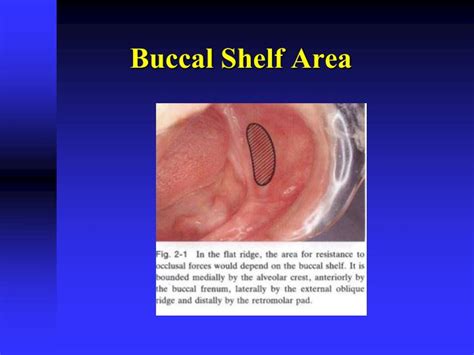 PPT - Anatomy of Mandibular Denture Bearing Area PowerPoint ...