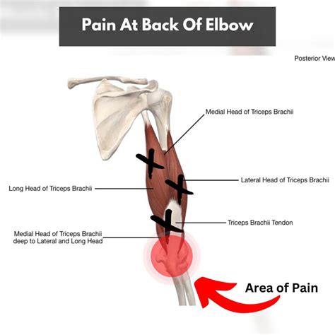 A Helpful Guide to Triceps Tendonitis