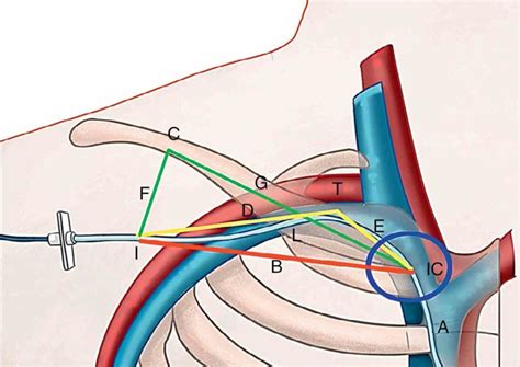 Vein para subclavian vein cvc insertion local anatomy and subclavain ...