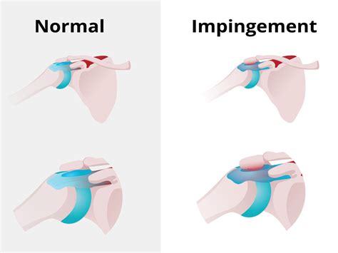 Shoulder Impingement — Han Orthopaedics