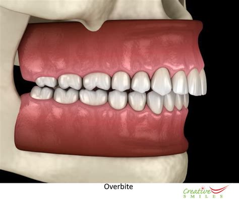 Overbite Teeth: What is an overbite or Buck Teeth?, Treatment, Causes ...