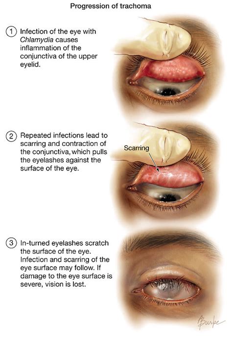 Trachoma | Cornea | JAMA | JAMA Network