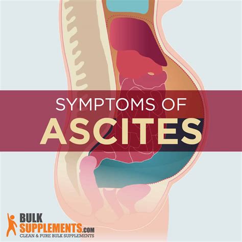 Ascites: Symptoms, Causes & Treatment