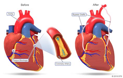 Coronary Artery Bypass Grafting (CABG) | The Patient Guide to Heart ...