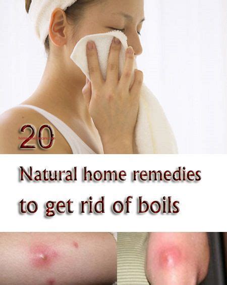 20 Natural Home Remedies to Get Rid of Boils | Natural home remedies ...